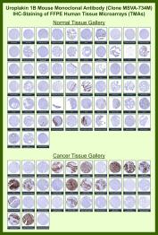 Uroplakin 1B Antibody for IHC Tissue Microarray (TMA). Immunohistochemistry analysis of Uroplakin 1B UPK1B in formalin-fixed paraffin-embedded human normal and cancer tissue microarrays using recombinant mouse monoclonal Uroplakin 1B antibody clone MSVA-734M. Tissue microarray (TMA) staining with HRP-DAB brown chromogen demonstrates membranous localization in urothelial cell populations, with strong signal observed in urothelial tissues and urothelial carcinoma samples, while most non-urothelial tissues show minimal staining. This selective staining pattern supports the role of UPK1B as a urothelial differentiation marker and enables clear identification of urothelial-derived cells in tissue sections. Evaluation across large TMA panels allows direct comparison of UPK1B expression across diverse tissue types under standardized conditions. The observed staining patterns align with reported UPK1B expression profiles in the Human Protein Atlas.