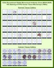 CD3e Antibody for IHC Tissue Microarray (TMA). Immunohistochemistry analysis of CD3 epsilon chain / CD3E in formalin-fixed paraffin-embedded human normal and cancer tissue microarrays using recombinant rabbit monoclonal CD3e antibody clone MSVA-003R. Tissue microarray (TMA) staining with HRP-DAB brown chromogen demonstrates membranous and cytoplasmic localization in T lymphocyte populations, with strong signal observed in lymphoid tissues such as tonsil and lymph node, highlighting interfollicular and paracortical T-cell zones, while non-lymphoid parenchymal cells remain largely negative. Within tumor tissue microarrays, variable densities of tumor-infiltrating T lymphocytes are detected within stromal compartments and at invasive margins, supporting its use as a pan-T cell marker for evaluating immune infiltration. Evaluation across large TMA panels enables direct comparison of CD3E expression across diverse tissue types under standardized conditions. The observed staining patterns align with reported CD3E expression profiles in the Human Protein Atlas.