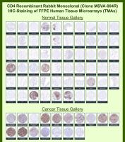 CD4 Antibody for IHC Tissue Microarray (TMA). Immunohistochemistry analysis of CD4 molecule / CD4 in formalin-fixed paraffin-embedded human normal and cancer tissue microarrays using recombinant rabbit monoclonal CD4 antibody. Tissue microarray (TMA) staining with HRP-DAB brown chromogen demonstrates membranous localization in CD4-positive T lymphocyte populations, with strong signal observed in lymphoid tissues and scattered immune cells across multiple organs, while non-immune cell types remain largely negative. Within tumor tissue microarrays, variable densities of CD4-positive T helper cells are detected in tumor microenvironments, including lymphomas and carcinomas, supporting evaluation of immune infiltration and tumor-associated lymphocyte populations. Evaluation across large TMA panels enables direct comparison of CD4 expression across diverse tissue types under standardized conditions. The observed staining patterns align with reported CD4 expression profiles in the Human Protein Atlas.