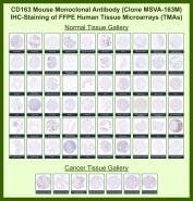 CD163 Antibody for IHC Tissue Microarray (TMA). Immunohistochemistry analysis of CD163 (Cluster of Differentiation 163) expression across formalin-fixed, paraffin-embedded human tissue microarrays using CD163 Immunohistochemistry Antibody clone MSVA-163M. The array contains a broad range of normal and cancer tissues, showing strong membranous and cytoplasmic HRP-DAB brown staining in macrophage populations, with prominent labeling in spleen, liver, lung, and lymphoid tissues, while most non-hematopoietic parenchymal cells remain negative. In cancer tissue arrays, CD163-positive tumor-associated macrophages are variably enriched within tumor stroma and at invasive margins, highlighting macrophage infiltration patterns consistent with tumor microenvironment remodeling and immunosuppressive signaling. The staining profile aligns with known CD163 expression patterns and Human Protein Atlas data.