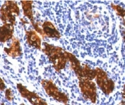 Thyroglobulin Antibody Clone TG157-2. Immunohistochemistry analysis of Thyroglobulin using Thyroglobulin Antibody Clone TG157-2 in FFPE human thyroid tissue section. HRP-DAB brown chromogenic staining highlights strong cytoplasmic signal in thyroid follicular epithelial cells forming thyroid follicles, with additional staining of follicular luminal colloid material. The staining pattern is characteristic of Thyroglobulin expression in differentiated thyroid follicular epithelium and reflects the well established use of Thyroglobulin as a marker of thyroid follicular cell differentiation.