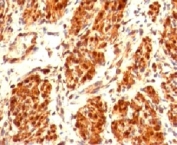 Calponin Antibody Uterus Immunohistochemistry. IHC testing of FFPE human uterus and Calponin antibody (clone CLPN5-1). Staining of formalin-fixed tissues requires boiling tissue sections in 10mM Tris with 1mM EDTA, pH 9, for 10-20 min followed by cooling at RT for 20 min.