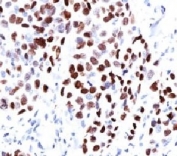 IHC testing of human lung squamous cell carcinoma (SCC) and p21 antibody (WAF21-1). Staining of formalin-fixed tissues requires boiling tissue sections in pH 9 10mM Tris with 1mM EDTA for 10-20 min followed by cooling at RT for 20 min