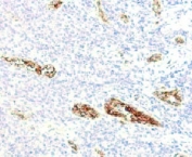 von Willebrand Factor Antibody / Megakaryocyte Lineage Marker Antibody. Immunohistochemistry analysis of human pancreas tissue shows HRP-DAB brown staining of endothelial cells lining vascular channels, with strong signal observed in vessel-associated regions. In addition to vascular endothelium, staining highlights scattered large cells consistent with megakaryocytic lineage features, supporting detection of platelet-producing cell populations. Endothelial-lined vessels and megakaryocyte-associated elements are clearly distinguished from surrounding pancreatic parenchymal cells. Clone WFA52-2 enables visualization of both vascular structures and megakaryocyte-related signal within tissue. HIER: boil tissue sections in pH 9 10mM Tris with 1mM EDTA for 10-20 min.
