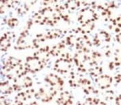 TTF-1 Antibody Human Thyroid IHC. Immunohistochemistry of TTF-1 Antibody / Pulmonary Epithelial Cell Marker Antibody in human thyroid tissue. FFPE human thyroid tissue stained using TTF-1 Antibody / Pulmonary Epithelial Cell Marker Antibody. The mouse monoclonal clone HBNK2-1 antibody demonstrates strong nuclear staining in thyroid follicular epithelial cells, consistent with the nuclear localization of Thyroid transcription factor 1 (NKX2-1). NKX2-1 is a lineage-associated transcription factor expressed in both pulmonary epithelial cells of the respiratory epithelium and thyroid follicular epithelial cells, reflecting the shared developmental origin of these epithelial tissues. Thyroid tissue therefore provides a well-established epithelial lineage control for TTF-1 antibody staining while the protein also serves as a marker of pulmonary epithelial cells, including alveolar epithelial cells within lung tissue. Required HIER: boil FFPE tissue sections in pH6 10mM citrate buffer for 10-20 minutes followed by cooling at RT for 20 minutes.