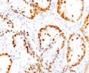 TTF-1 Antibody Human Lung IHC. Immunohistochemistry of TTF-1 Antibody / Pulmonary Epithelial Cell Marker Antibody in human lung tissue. FFPE human lung tissue stained using TTF-1 Antibody / Pulmonary Epithelial Cell Marker Antibody. The mouse monoclonal clone HBNK2-1 antibody demonstrates strong nuclear staining in pulmonary epithelial cells lining the respiratory epithelium, including alveolar epithelial cells consistent with type II pneumocytes. Nuclear immunoreactivity for Thyroid transcription factor 1 (NKX2-1) highlights pulmonary epithelial lineage and identifies epithelial cells of the respiratory epithelium within lung tissue. This staining pattern reflects the established role of TTF-1 as a pulmonary epithelial cell marker used in immunohistochemistry to study alveolar epithelial differentiation and respiratory epithelial cell populations. Required HIER: boil FFPE tissue sections in pH6 10mM citrate buffer for 10-20 minutes followed by cooling at RT for 20 minutes.