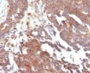 IHC testing of FFPE human ovarian carcinoma and GnRHR antibody (clone LCHR37). Staining of formalin-fixed tissues requires boiling tissue sections in 10mM Tris with 1mM EDTA, pH 9, for 10-20 min followed by cooling at RT for 20 min.