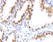 AR Antibody for IHC (clone ANDRC-1) immunohistochemistry of human prostate carcinoma. Formalin-fixed, paraffin-embedded human prostate carcinoma tissue stained with the mouse monoclonal AR Antibody for IHC (clone ANDRC-1) shows strong nuclear HRP-DAB brown chromogenic staining in malignant glandular epithelial cells, consistent with androgen receptor expression and the expected nuclear localization of this ligand-activated steroid hormone receptor. Surrounding stromal elements display minimal staining, highlighting the predominance of AR-positive tumor epithelial nuclei within the carcinoma tissue.