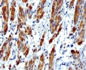 IHC testing of FFPE human Leiomyosarcoma with SMMHC Antibody SMM11-1. FFPE testing requires sections to be boiled in pH 9 10mM Tris with 1mM EDTA for 10-20 minutes, followed by cooling at RT for 20 minutes, prior to staining.