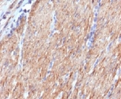 IHC testing of FFPE human colon carcinoma with SMMHC Antibody SMM11-1. FFPE testing requires sections to be boiled in pH 9 10mM Tris with 1mM EDTA for 10-20 minutes, followed by cooling at RT for 20 minutes, prior to staining.