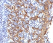 Immunohistochemistry of Keratin 14 / KRT14 in human prostate tissue. Formalin-fixed, paraffin-embedded human prostate tissue stained with Keratin 14 antibody (clone CTKN14-1) shows cytoplasmic staining in a subset of epithelial cells, with signal localized to basal-type cells, while surrounding stromal and luminal epithelial cells show minimal staining. Antigen retrieval was performed by boiling tissue sections in 10 mM Tris with 1 mM EDTA, pH 9.0, for 10-20 minutes, followed by cooling at room temperature for 20 minutes.