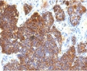 Parathyroid Hormone Antibody C Terminus immunohistochemistry of human parathyroid gland. FFPE human parathyroid tissue stained with Parathyroid Hormone Antibody C Terminus clone PRTM1-3, a mouse monoclonal antibody recognizing the C-terminal region of Parathyroid hormone (PTH). Strong cytoplasmic brown chromogenic staining is observed in parathyroid endocrine chief cells, consistent with the expected intracellular localization of Parathyroid hormone within hormone-producing cells of the parathyroid gland. Immunohistochemistry staining was performed following heat-induced epitope retrieval by boiling tissue sections in pH 9 10mM Tris with 1mM EDTA for 10-20 minutes, followed by cooling at room temperature for 20 minutes prior to staining.