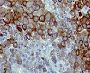 IHC testing of FFPE human melanoma with CD271 antibody (clone CDLA271).