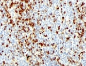 ZAP70 Antibody / Lymphocyte Differentiation and Effector Programming Antibody. Immunohistochemistry analysis of formalin-fixed, paraffin-embedded human tonsil tissue using ZAP70 Antibody / Lymphocyte Differentiation and Effector Programming Antibody (clone ZTP70-1). Cytoplasmic HRP-DAB brown staining is observed in lymphoid cell populations within tonsillar follicles and interfollicular regions, with heterogeneous staining intensity across cells. This pattern is consistent with Zeta-chain-associated protein kinase 70 (ZAP70) expression and reflects differences in signaling states associated with lymphocyte differentiation and effector programming. The distribution highlights subsets of lymphocytes undergoing distinct functional specialization, supporting the role of ZAP70 in shaping immune cell fate within lymphoid tissue architecture.