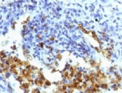 Napsin A Antibody for IHC. Immunohistochemistry analysis of Napsin A (NAPSA) expression in FFPE human lung adenocarcinoma demonstrates strong granular cytoplasmic HRP-DAB brown staining in tumor epithelial cells with minimal background in surrounding stromal regions. Clone NPSNA-1 highlights Napsin A expression consistent with its role in surfactant protein processing in alveolar epithelial cells, supporting identification of enzyme-associated epithelial differentiation within tumor tissue. HIER was performed by boiling tissue sections in pH 9 10mM Tris with 1mM EDTA for 10-20 minutes followed by cooling at RT for 20 minutes prior to staining.