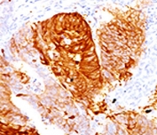 ALDH1 Antibody Colon Cancer Immunohistochemistry. IHC testing of FFPE human colon carcinoma with ALDH1 antibody (clone AHDH1-1).