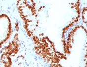 FOXA1 Antibody Human Prostate Carcinoma IHC. Immunohistochemical staining of FFPE human prostate carcinoma tissue using FOXA1 Antibody (clone FHBA1-1) demonstrates strong nuclear HRP-DAB brown staining within malignant epithelial cell populations. The staining pattern is consistent with expression of FOXA1, a forkhead family transcription factor that functions as a developmental regulator of gene expression, epithelial differentiation, and tissue-specific transcriptional programs. The prominent nuclear localization is characteristic of a DNA-binding transcription factor and supports the role of FOXA1 in maintaining epithelial lineage identity and regulating gene networks associated with cellular differentiation and tissue development. Staining of FFPE tissue is enhanced by boiling sections in 10 mM Tris with 1 mM EDTA, pH 9 for 10-20 minutes followed by cooling at room temperature for 20 minutes.