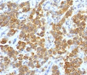 TL1A Antibody for IHC Parathyroid Tumor. Immunohistochemistry of TL1A antibody in human parathyroid tumor tissue. FFPE human parathyroid lesion demonstrates diffuse cytoplasmic and membranous HRP-DAB brown staining within tumor cells, consistent with VEGI / TNFSF15 expression in endocrine-associated tissue. Clone TLRM1-1 was used as a monoclonal antibody for detection. Heat-induced epitope retrieval was performed by boiling sections in 10 mM Tris with 1 mM EDTA, pH 9, for 10-20 minutes followed by cooling at room temperature for 20 minutes prior to staining.