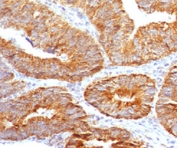 TL1A Antibody for IHC Colon Carcinoma. Immunohistochemistry of TL1A antibody in human colon carcinoma tissue. FFPE human colon carcinoma demonstrates strong membranous and cytoplasmic HRP-DAB brown staining within gland-forming tumor epithelial cells, consistent with VEGI / TNFSF15 localization in epithelial and vascular-associated compartments. Clone TLRM1-1 was used as a monoclonal antibody for detection. Heat-induced epitope retrieval was performed by boiling sections in 10 mM Tris with 1 mM EDTA, pH 9, for 10-20 minutes followed by cooling at room temperature for 20 minutes prior to staining.