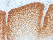 CD44v4 Antibody for IHC Cervical Squamous Cell Carcinoma. Immunohistochemistry analysis of CD44 variant 4 / CD44 expression in FFPE human cervical squamous cell carcinoma using recombinant rabbit monoclonal antibody clone CD44v4/1700R. Strong, continuous membranous HRP-DAB brown staining is observed in malignant squamous epithelial cells, clearly outlining cell borders and preserving epithelial layering consistent with CD44v4-associated cell adhesion and tissue organization. The staining pattern highlights cohesive tumor architecture and supports its use as a marker of epithelial integrity and structural organization in squamous cell carcinoma. Heat induced epitope retrieval was performed by steaming tissue sections in pH 9 10mM Tris with 1mM EDTA buffer for 20 min before testing.