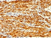 Calponin Antibody Uterus IHC. Immunohistochemistry analysis of FFPE human uterus tissue using Calponin antibody. The recombinant rabbit monoclonal antibody clone CNN1/1408R shows strong HRP-DAB brown cytoplasmic staining in smooth muscle cells of the myometrial layer, with signal distributed along contractile fibers consistent with Calponin 1 / CNN1 localization. Surrounding stromal components display minimal background staining, supporting specificity for smooth muscle-associated cytoskeletal structures. HIER: steam sections in 1 mM EDTA, pH 9, for 10-20 min followed by cooling at RT for 20 min.