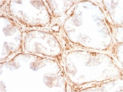 LGALS1 Antibody Prostate Carcinoma IHC. Immunohistochemical staining of FFPE human prostate carcinoma tissue using recombinant LGALS1 antibody (clone GAL1/2499R) demonstrates prominent cytoplasmic and stromal-associated HRP-DAB brown staining within the tumor microenvironment. Strong immunoreactivity is observed in fibroblast-like stromal cells and connective tissue structures surrounding malignant glandular elements, consistent with the known expression pattern of LGALS1, a beta-galactoside-binding lectin involved in immune regulation, extracellular matrix remodeling, angiogenesis, and tumor progression. The staining pattern highlights the important role of LGALS1 in tumor-stromal interactions and supports the use of recombinant clone GAL1/2499R for detection of LGALS1 expression in FFPE tissue specimens. HIER: boil tissue sections in 10mM citrate buffer, pH 6, for 10-20 min and allow to cool before testing.