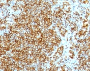 HCAM Antibody Lymph Node IHC. Immunohistochemistry analysis of HCAM / CD44 expression in FFPE human lymph node tissue using Cell Migration and Immune Trafficking Marker Antibody clone HCM15-2R. Membranous HRP-DAB brown staining is observed in dense lymphoid cell populations, highlighting widespread cell surface localization consistent with HCAM/CD44 expression on migrating immune cells. The staining pattern demonstrates clustered distribution within lymphoid regions and supports its use for evaluating immune cell trafficking, spatial organization, and microenvironment-associated cell movement in lymph node tissue. Heat induced epitope retrieval was performed by boiling tissue sections in pH 6 10 mM citrate buffer for 10-20 min followed by cooling at RT for 20 min.