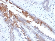 Mammaglobin Antibody Rabbit Monoclonal MGB/2123R immunohistochemistry of human breast carcinoma. FFPE human breast carcinoma tissue was stained with Mammaglobin Antibody Rabbit Monoclonal (clone MGB/2123R). HRP-DAB brown chromogenic signal highlights cytoplasmic staining in tumor epithelial cells forming glandular structures, consistent with expression of Mammaglobin A / SCGB2A2 in breast carcinoma cells, while surrounding stromal cells show little to no staining. Heat-induced epitope retrieval was performed by boiling tissue sections in 10mM citrate buffer (pH6) for 10-20 minutes followed by cooling at room temperature prior to staining.
