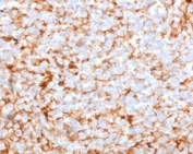 Recombinant Mammaglobin A Antibody MMGA-1R immunohistochemistry of human breast carcinoma. FFPE human breast carcinoma tissue was stained with Recombinant Mammaglobin A Antibody (clone MMGA-1R). HRP-DAB brown chromogenic signal highlights cytoplasmic staining in tumor epithelial cells distributed throughout the carcinoma tissue, consistent with expression of Mammaglobin A / SCGB2A2 in breast carcinoma cells, while surrounding stromal elements show minimal staining. Heat-induced epitope retrieval was performed by boiling tissue sections in 10mM citrate buffer (pH6) for 10-20 minutes followed by cooling prior to testing.