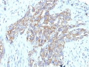 IHC staining of FFPE human lung carcinoma tissue with CD56 antibody (clone 123C3.D5 + 123A8). HIER: boil tissue sections in pH9 EDTA buffer for 10-20 min followed by cooling at RT for 20 min.