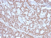 Progesterone Receptor Antibody IHC. Immunohistochemistry analysis of Progesterone Receptor Antibody - Protein Microarray Validated clone PGR/2694 in human endometrial carcinoma tissue. FFPE human endometrial carcinoma tissue was stained with the mouse monoclonal Progesterone Receptor antibody (clone PGR/2694) following heat induced epitope retrieval by boiling sections in pH6 10mM citrate buffer for 10-20 minutes. HRP-DAB brown chromogenic signal reveals strong nuclear staining in tumor epithelial cells, consistent with the known nuclear localization of Progesterone receptor (PGR) in hormone-responsive endometrial carcinoma cells.