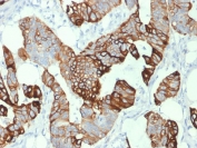 CK20 Antibody for IHC (clone KRT20/1993). Immunohistochemistry analysis of human colon carcinoma tissue using mouse monoclonal CK20 antibody (clone KRT20/1993). HRP-DAB brown chromogenic staining highlights cytoplasmic Keratin 20 / Cytokeratin 20 (KRT20) expression in malignant epithelial cells forming glandular structures, while surrounding stromal cells remain largely negative. The staining pattern reflects the known epithelial localization of this intermediate filament protein in colorectal carcinoma. Required HIER: boil tissue sections in 10 mM citrate buffer, pH 6, for 10-20 min followed by cooling at RT for 20 min.
