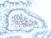 BMI1 Antibody FFEP Human Colon Carcinoma IHC. Immunohistochemistry testing of FFPE human colon carcinoma with BMI1 antibody (clone BMI1/2689). HIER: boil tissue sections in pH 9 10mM Tris with 1mM EDTA for 10-20 min followed by cooling at RT for 20 min.