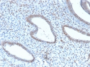 TLE1 Antibody / Transducin-Like Enhancer Protein 1 immunohistochemistry analysis of human endometrial carcinoma using clone TLE1/2946R. Formalin-fixed paraffin-embedded human endometrial carcinoma tissue shows nuclear staining in tumor cells consistent with expression of Transducin-Like Enhancer Protein 1, a nuclear Groucho family transcriptional corepressor. TLE1 protein localization is primarily nuclear, reflecting its role in transcriptional repression complexes that regulate developmental signaling pathways including Notch and Wnt. The recombinant rabbit monoclonal clone TLE1/2946R antibody highlights nuclear staining within malignant epithelial cells while surrounding stromal elements show weaker or absent staining. Heat-induced epitope retrieval was performed by boiling tissue sections in pH 9 Tris-EDTA buffer for 10-20 minutes followed by cooling prior to antibody staining.
