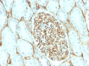 CD34 Antibody Renal Cell Carcinoma IHC. Immunohistochemistry testing of FFPE human renal cell carcinoma with recombinant CD34 antibody (clone HPCA1/2598R). Required HIER: boil tissue sections in 10mM Tris with 1mM EDTA, pH 9, for 10-20 min followed by cooling at RT for 20 min.