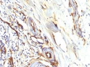 CD34 Antibody Colon Carcinoma IHC. Immunohistochemistry testing of FFPE human colon carcinoma with recombinant CD34 antibody (clone HPCA1/2598R). Required HIER: boil tissue sections in 10mM Tris with 1mM EDTA, pH 9, for 10-20 min followed by cooling at RT for 20 min.
