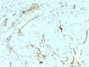 CD34 Antibody Breast Cancer IHC. Immunohistochemistry testing of FFPE human breast carcinoma with recombinant CD34 antibody (clone HPCA1/2598R). Required HIER: boil tissue sections in 10mM Tris with 1mM EDTA, pH 9, for 10-20 min followed by cooling at RT for 20 min.