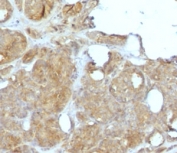 MVP Antibody for IHC. Immunohistochemistry analysis of Major Vault Protein (MVP / LRP) expression in FFPE human breast carcinoma using clone MJVP-1R mouse monoclonal antibody. Tumor epithelial cells exhibit moderate to strong cytoplasmic HRP-DAB brown staining with a diffuse to granular pattern, consistent with intracellular vault complex localization, while surrounding stromal elements show lower background signal. The staining highlights malignant cell populations within tumor nests, supporting the association of Major vault protein with tumor cell survival and drug resistance-related cellular stress pathways. Heat-induced epitope retrieval was performed in pH 9 10mM Tris with 1mM EDTA for 10-20 minutes followed by cooling prior to antibody incubation.