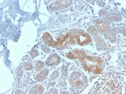 MVP Antibody Breast Carcinoma IHC. Immunohistochemistry analysis of Major Vault Protein (MVP / LRP) expression in FFPE human breast carcinoma using clone VP2897R rabbit monoclonal antibody. Tumor epithelial cells exhibit moderate cytoplasmic HRP-DAB brown staining with a diffuse to finely granular pattern, consistent with vault complex structural localization, while surrounding stromal regions show comparatively lower signal. The staining highlights gland-forming tumor structures and cellular architecture, supporting the role of Major vault protein as a core structural component of vault particles within malignant epithelial cells. Heat-induced epitope retrieval was performed in pH 9 10mM Tris with 1mM EDTA for 10-20 minutes followed by cooling prior to antibody incubation.