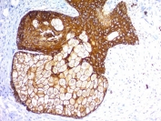 Pan Cytokeratin Antibody human skin IHC. Immunohistochemistry analysis of cytokeratin expression in FFPE human skin using Pan Cytokeratin antibody clones KRTL/1577R + KRTH/1576R. Strong cytoplasmic HRP-DAB brown staining highlights epithelial cells within the epidermis, clearly outlining keratinocyte morphology and cytoskeletal organization, while underlying dermal tissue remains largely negative. The staining pattern supports visualization of epithelial structure and tissue architecture. HIER was performed using pH 6 citrate buffer for 10â20 minutes followed by cooling prior to antibody incubation.