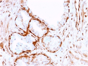 Aldose Reductase Antibody Prostate Cancer IHC. Immunohistochemistry analysis of FFPE human prostate cancer tissue stained with Aldose reductase antibody clone CPTC-AKR1B1-3. Strong cytoplasmic HRP-DAB brown staining is observed within prostate tumor epithelial cells, consistent with the expected intracellular localization of Aldose reductase / AKR1B1, a polyol pathway-associated metabolic enzyme involved in glucose metabolism and oxidative stress-responsive signaling pathways. Tissue sections underwent HIER using 10mM citrate buffer, pH 6, prior to immunostaining.