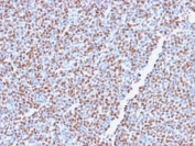 ALK Antibody Recombinant ALCL IHC. Immunohistochemistry staining of FFPE human anaplastic large-cell lymphoma tissue using recombinant monoclonal clone ALK1/2766R demonstrates diffuse nuclear and cytoplasmic HRP-DAB brown staining across malignant lymphoid cell populations, consistent with expression of oncogenic ALK fusion-associated protein in ALK-positive lymphoma. The staining pattern reinforces the established association between ALK rearrangement-driven kinase signaling and anaplastic large-cell lymphoma pathobiology. HIER: boil tissue sections in 10mM Tris buffer with 1mM EDTA, pH 9, for 10-20 min followed by cooling at room temperature for 20 min.