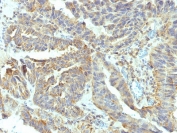 ALPL Antibody Ovaria Carcinoma IHC. Immunohistochemistry testing of FFPE human ovarian carcinoma with ALPL antibody (clone V17.1). Required HIER: boil tissue sections in 10mM Tris with 1mM EDTA, pH 9, for 10-20 min followed by cooling at RT for 20 min.