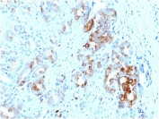 FTL Antibody Prostate IHC. Immunohistochemistry analysis of FFPE human prostate tissue stained with FTL Antibody demonstrates granular cytoplasmic HRP-DAB brown staining within glandular epithelial cell populations, consistent with expression of ferritin light chain / FTL in metabolically active secretory epithelial compartments. This ferritin complex assembly antibody highlights intracellular ferritin-associated iron sequestration pathways and oxidative stress-responsive cellular regulation in prostate tissue. HIER: boil tissue sections in 10mM citrate buffer, pH 6, for 10-20 min and allow to cool before testing.