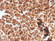 Immunohistochemistry of GP2 Antibody Recombinant Rabbit MAb in human pancreas. Formalin-fixed, paraffin-embedded human pancreas tissue was stained using GP2 Antibody Recombinant Rabbit MAb GP2/3134R. Heat-induced epitope retrieval was performed by boiling tissue sections in pH 9 10mM Tris with 1mM EDTA. HRP-DAB brown staining highlights pancreatic acinar cells with strong cytoplasmic and apical localization, consistent with the known distribution of Glycoprotein 2 within zymogen granules of exocrine pancreatic cells. Surrounding stromal tissue and pancreatic ductal structures show minimal staining.