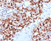 Immunohistochemistry analysis of MSH6 antibody in human colon carcinoma tissue. MSH6 Antibody Mouse Monoclonal MTS6-1 was used for immunohistochemistry on FFPE human colon carcinoma tissue. Prominent HRP-DAB brown nuclear staining is observed in malignant epithelial cells, consistent with the nuclear localization of MutS homolog 6 (MSH6), a DNA mismatch repair protein that recognizes replication-associated base mismatches. Tumor cell nuclei show strong positive labeling across gland-forming carcinoma regions, while surrounding stromal cells demonstrate comparatively weaker staining. Heat-induced epitope retrieval was performed by boiling tissue sections in pH 9 10mM Tris with 1mM EDTA for 10-20 min followed by cooling prior to immunostaining.
