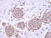 Mammaglobin Antibody immunohistochemistry of human breast carcinoma. FFPE human breast carcinoma tissue was stained with recombinant Mammaglobin antibody (clone MGB/2682R). HRP-DAB brown chromogenic signal highlights cytoplasmic staining in tumor epithelial cells forming glandular structures, consistent with expression of Mammaglobin A / SCGB2A2 in breast carcinoma cells, while surrounding stromal cells show little to no staining. Heat-induced epitope retrieval was performed by boiling tissue sections in 10mM citrate buffer (pH6) for 10-20 minutes followed by cooling at room temperature prior to staining.