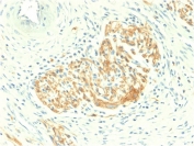 IHC staining of FFPE human colon carcinoma with CD56 antibody (clone NCAM1/2217R). HIER: boil tissue sections in pH6, 10mM citrate buffer, for 10-20 min followed by cooling at RT for 20 min.