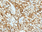 CD34 Antibody for human RCC IHC. Immunohistochemistry analysis of CD34 expression in FFPE human renal cell carcinoma using clone CDLA34-2R, demonstrates strong membranous HRP-DAB brown staining in tumor-associated vascular endothelial cells outlining dense microvascular networks, while surrounding tumor cells remain largely negative. The staining pattern highlights prominent tumor angiogenesis and vascular architecture within renal cell carcinoma. Required HIER: boil tissue sections in 10mM Tris with 1mM EDTA, pH 9, for 10-20 min followed by cooling at RT for 20 min.