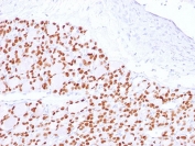 PAX8 Antibody / Thyroid Differentiation Marker Antibody immunohistochemistry in human thyroid tissue showing strong nuclear HRP-DAB brown staining in follicular epithelial cells. Paired box protein Pax-8 (PAX8) expression is localized to nuclei of thyroid follicular cells lining colloid-filled follicles, with clear sparing of colloid material and surrounding stromal tissue. The staining pattern highlights dense follicular epithelial populations with expected nuclear positivity, while non-epithelial cells remain negative with hematoxylin-only nuclear counterstain. This distinct nuclear localization supports the role of PAX8 as a thyroid lineage transcription factor and reinforces its utility as a differentiation marker in thyroid tissue analysis. Heat-induced epitope retrieval was performed by boiling tissue sections in 10mM Tris buffer with 1mM EDTA, pH 9, for 10-20 minutes followed by cooling prior to antibody incubation.